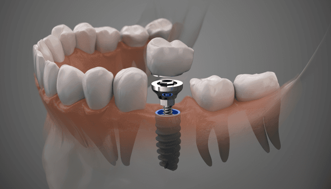 Dental Implants